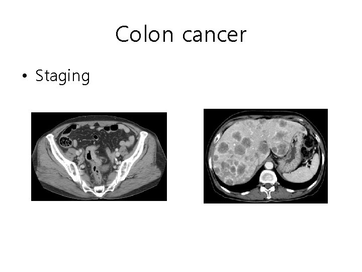 Colon cancer • Staging Colon cancer • Staging