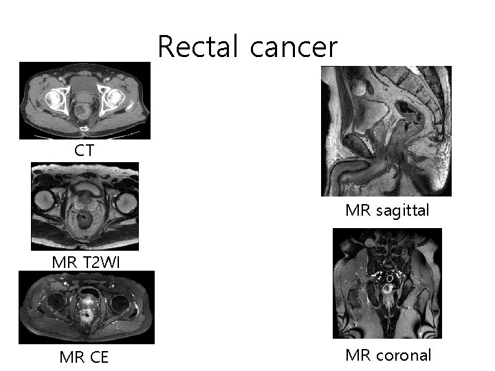 Rectal cancer CT MR sagittal MR T 2 WI MR CE MR coronal Rectal cancer CT MR sagittal MR T 2 WI MR CE MR coronal