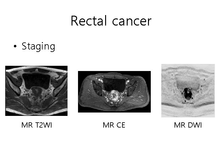 Rectal cancer • Staging MR T 2 WI MR CE MR DWI Rectal cancer • Staging MR T 2 WI MR CE MR DWI