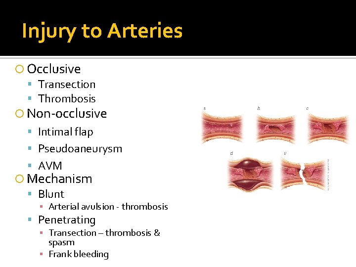 Injury to Arteries Occlusive Transection Thrombosis Non-occlusive Intimal flap Pseudoaneurysm AVM Mechanism Blunt ▪ Injury to Arteries Occlusive Transection Thrombosis Non-occlusive Intimal flap Pseudoaneurysm AVM Mechanism Blunt ▪