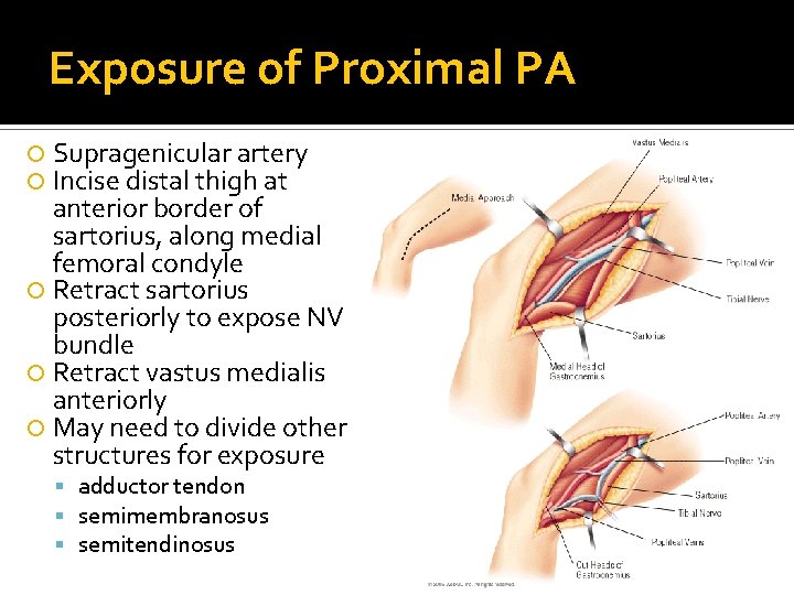 Exposure of Proximal PA Supragenicular artery Incise distal thigh at anterior border of sartorius, Exposure of Proximal PA Supragenicular artery Incise distal thigh at anterior border of sartorius,