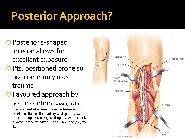 Posterior Approach? Posterior s-shaped incision allows for excellent exposure Pts. positioned prone so not Posterior Approach? Posterior s-shaped incision allows for excellent exposure Pts. positioned prone so not