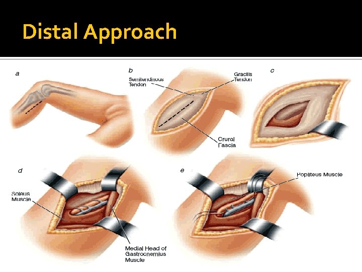 Distal Approach Distal Approach