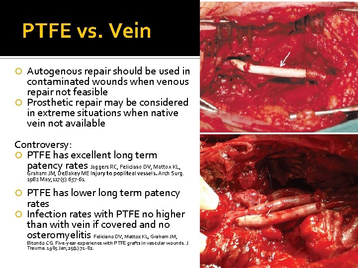 PTFE vs. Vein Autogenous repair should be used in contaminated wounds when venous repair PTFE vs. Vein Autogenous repair should be used in contaminated wounds when venous repair