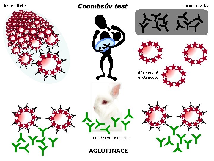 krev dítěte Coombsův test sérum matky dárcovské erytrocyty Coombsovo antisérum AGLUTINACE 