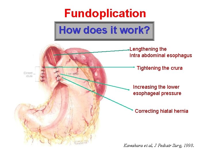 Fundoplication How does it work? Lengthening the Intra abdominal esophagus Tightening the crura Increasing