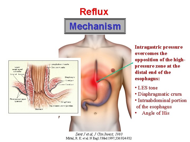 Reflux Mechanism Intragastric pressure overcomes the opposition of the highpressure zone at the distal