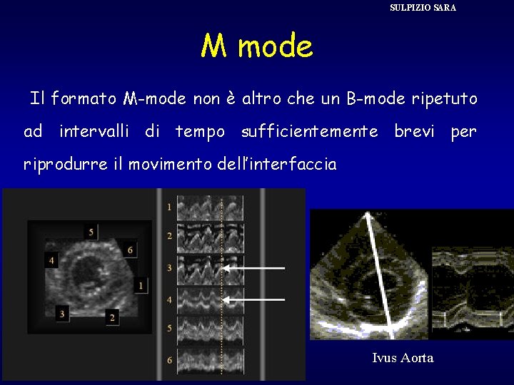SULPIZIO SARA M mode Il formato M-mode non è altro che un B-mode ripetuto