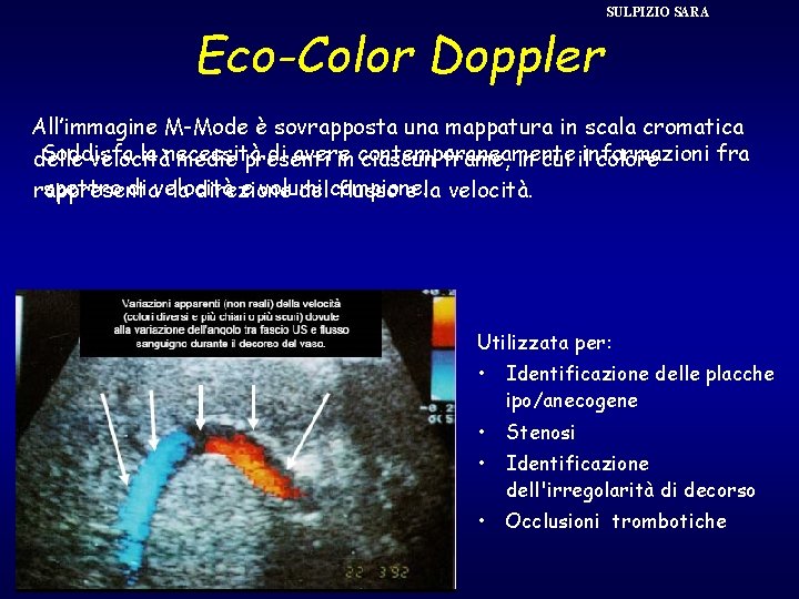 Eco-Color Doppler SULPIZIO SARA All’immagine M-Mode è sovrapposta una mappatura in scala cromatica Soddisfa