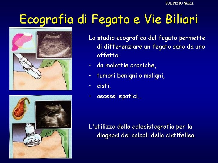 SULPIZIO SARA Ecografia di Fegato e Vie Biliari Lo studio ecografico del fegato permette