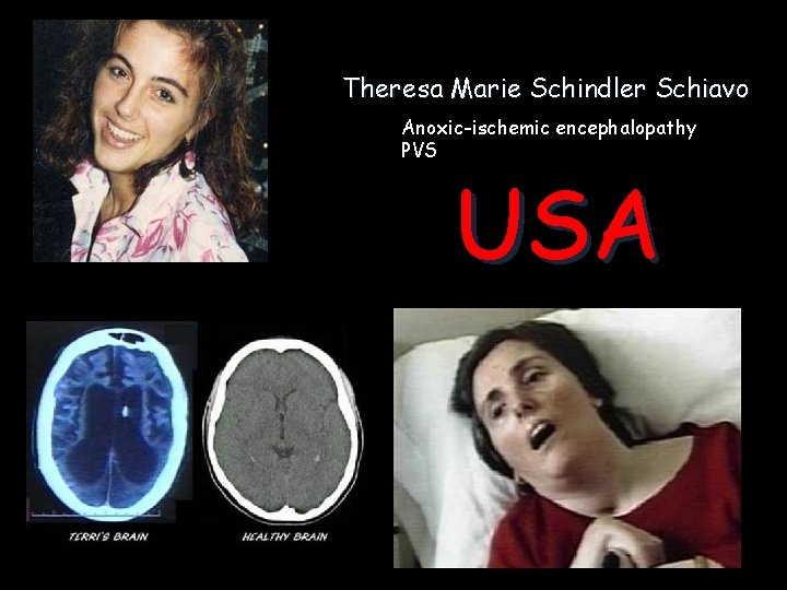 Theresa Marie Schindler Schiavo Anoxic-ischemic encephalopathy PVS USA 