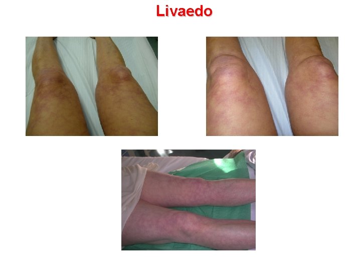 Livaedo 