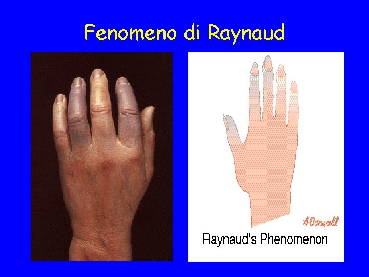 Fenomeno di Raynaud 