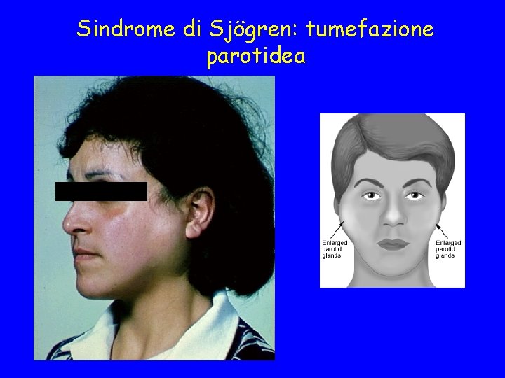 Sindrome di Sjögren: tumefazione parotidea 