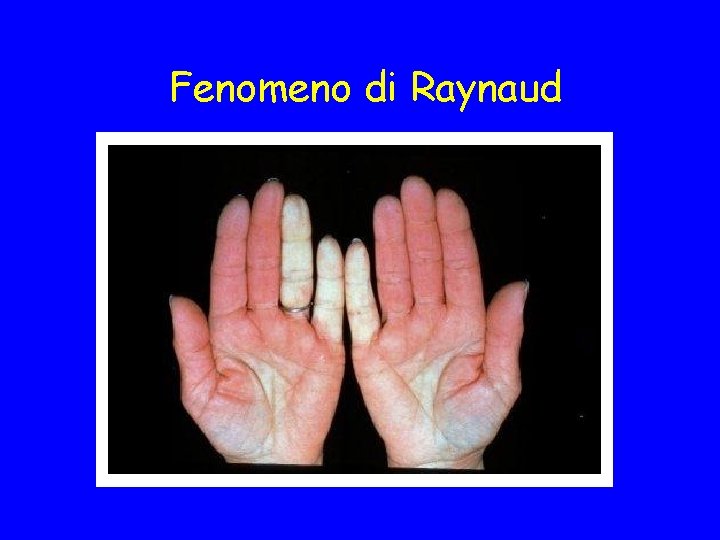 Fenomeno di Raynaud 