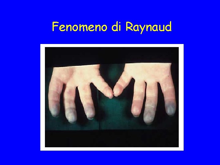 Fenomeno di Raynaud 