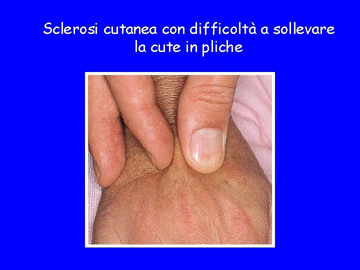 Sclerosi cutanea con difficoltà a sollevare la cute in pliche 