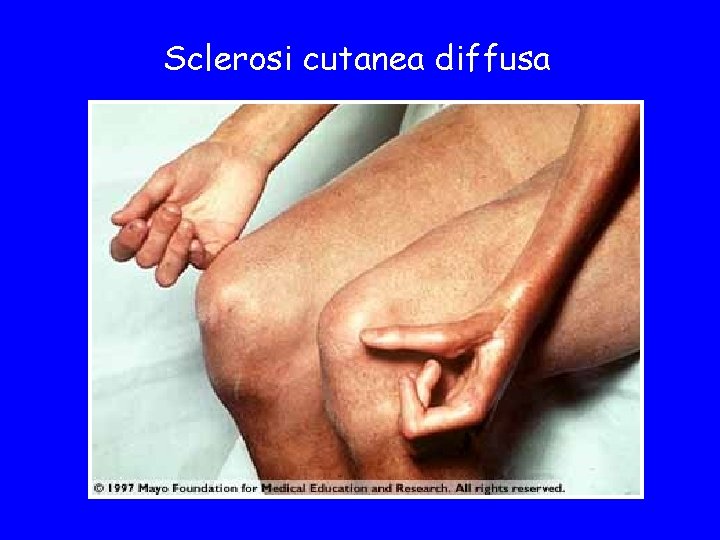 Sclerosi cutanea diffusa 