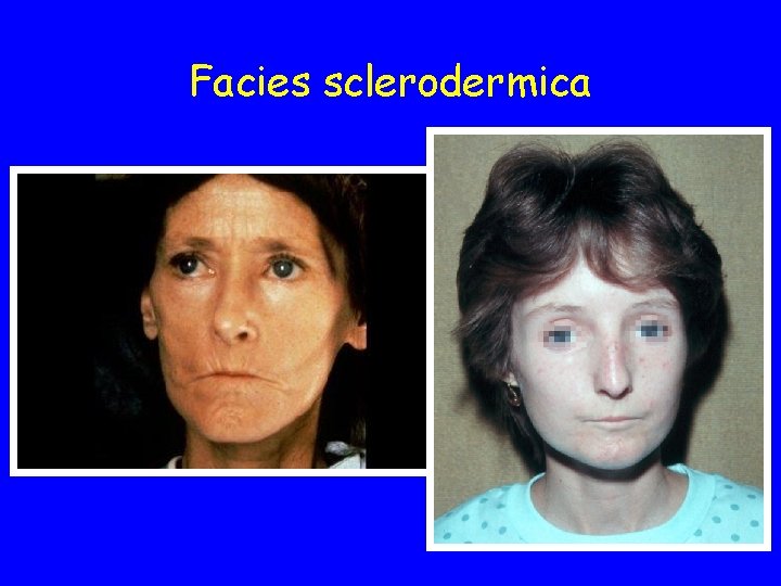Facies sclerodermica 