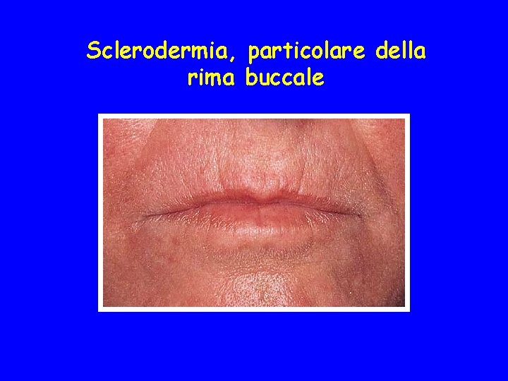 Sclerodermia, particolare della rima buccale 