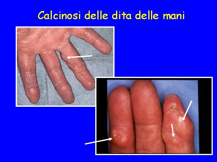 Calcinosi delle dita delle mani 