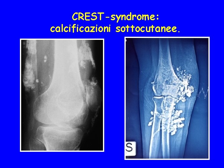  CREST-syndrome: calcificazioni sottocutanee. 