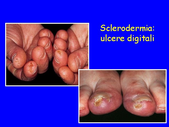 Sclerodermia: ulcere digitali 