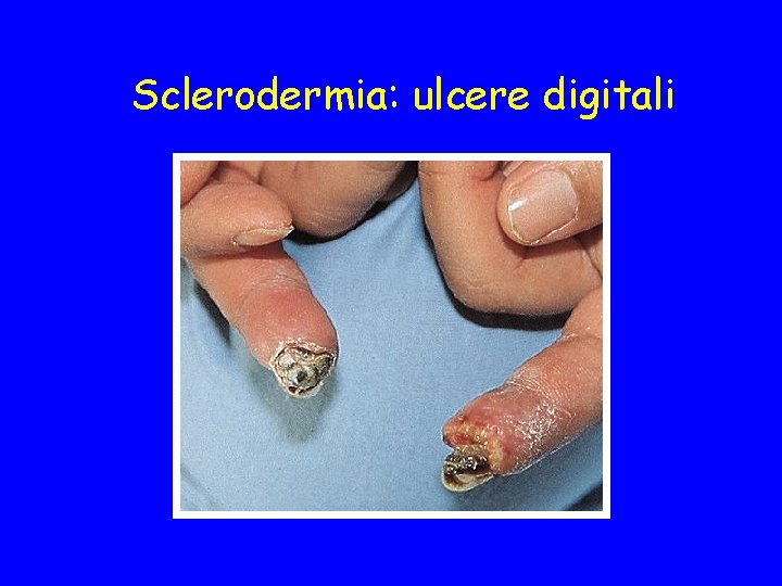 Sclerodermia: ulcere digitali 