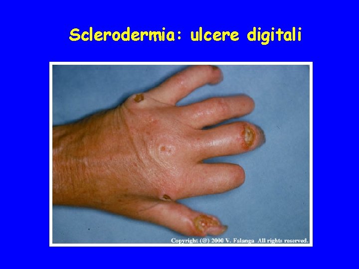 Sclerodermia: ulcere digitali 