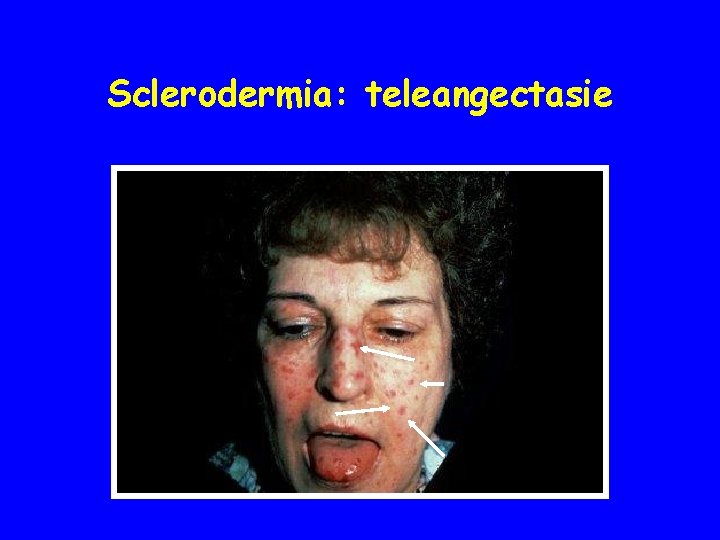 Sclerodermia: teleangectasie 