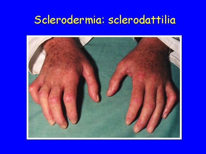 Sclerodermia: sclerodattilia 