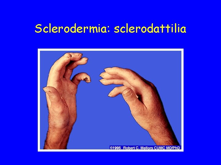 Sclerodermia: sclerodattilia 