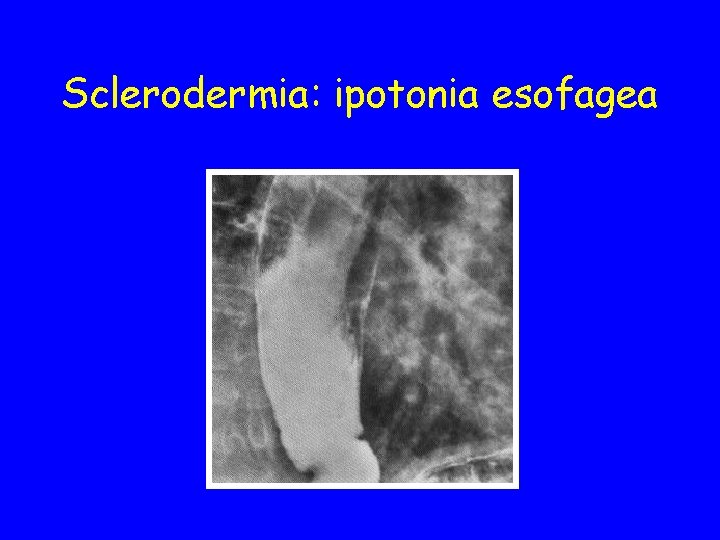 Sclerodermia: ipotonia esofagea 