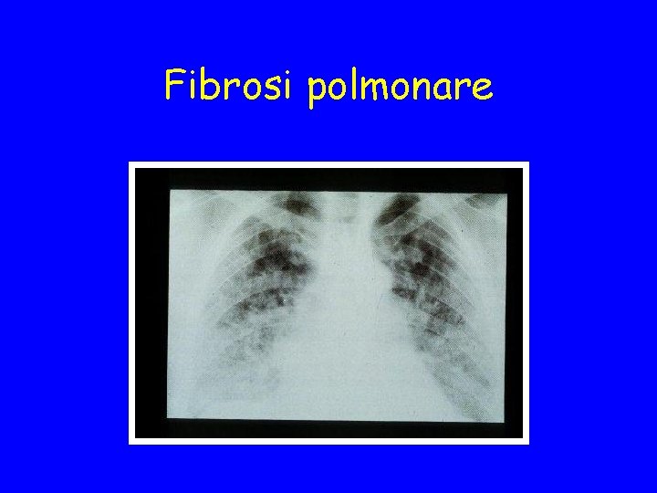 Fibrosi polmonare 