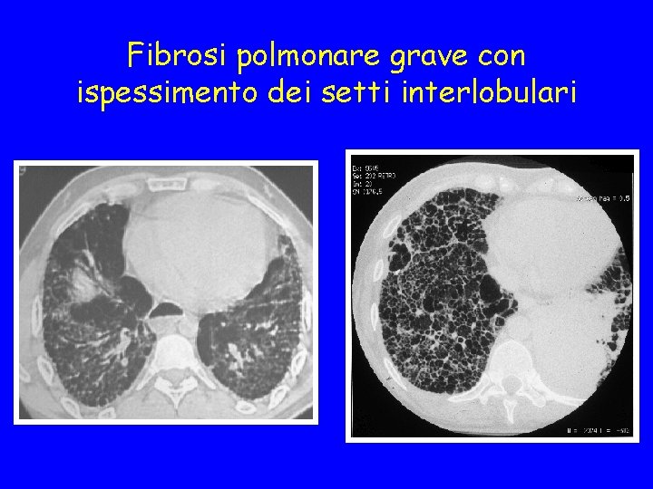 Fibrosi polmonare grave con ispessimento dei setti interlobulari 