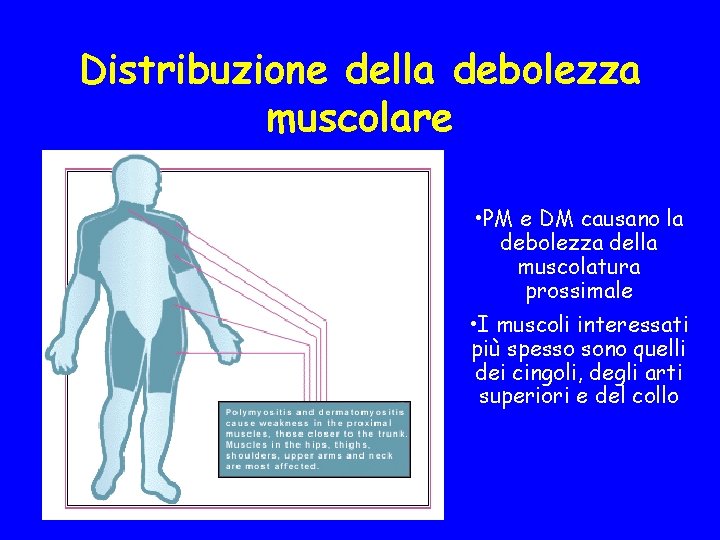 Distribuzione della debolezza muscolare • PM e DM causano la debolezza della muscolatura prossimale