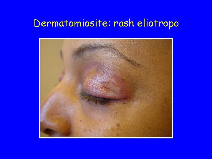Dermatomiosite: rash eliotropo 