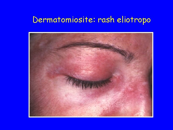 Dermatomiosite: rash eliotropo 
