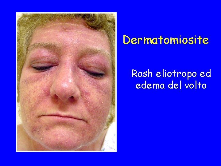 Dermatomiosite Rash eliotropo ed edema del volto 