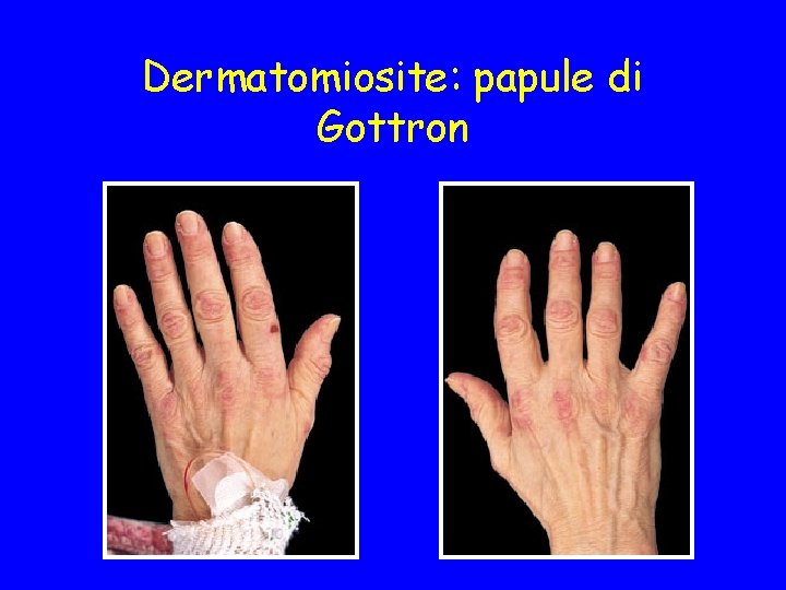 Dermatomiosite: papule di Gottron 