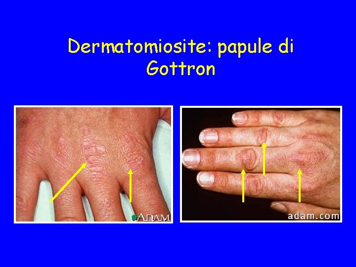 Dermatomiosite: papule di Gottron 