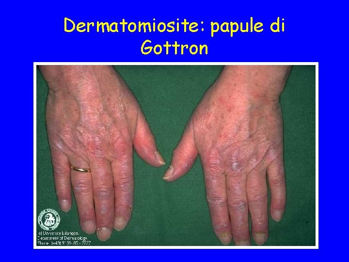 Dermatomiosite: papule di Gottron 