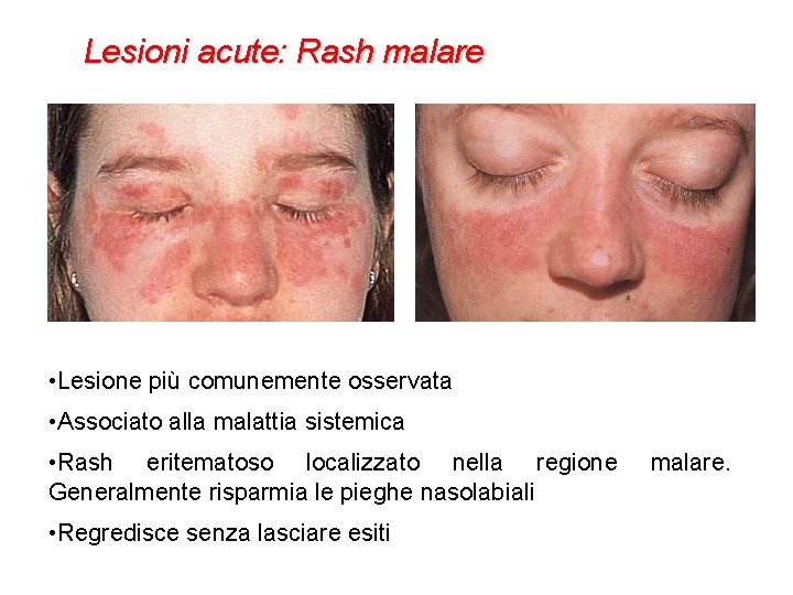 Lesioni acute: Rash malare • Lesione più comunemente osservata • Associato alla malattia sistemica