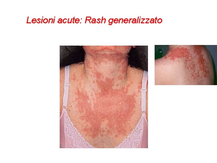 Lesioni acute: Rash generalizzato 