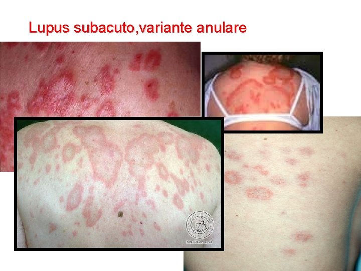 Lupus subacuto, variante anulare 