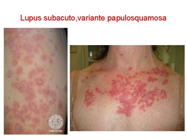 Lupus subacuto, variante papulosquamosa 