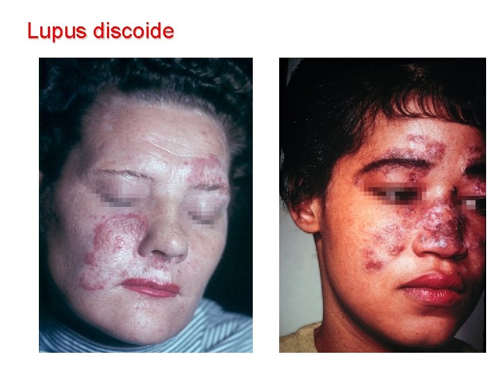 Lupus discoide 
