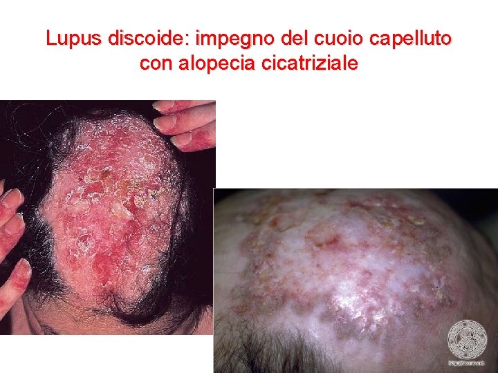 Lupus discoide: impegno del cuoio capelluto con alopecia cicatriziale 