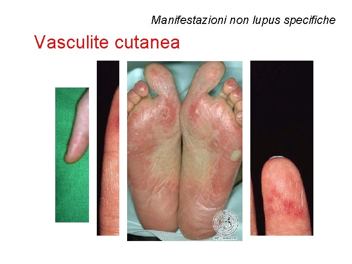 Manifestazioni non lupus specifiche Vasculite cutanea 