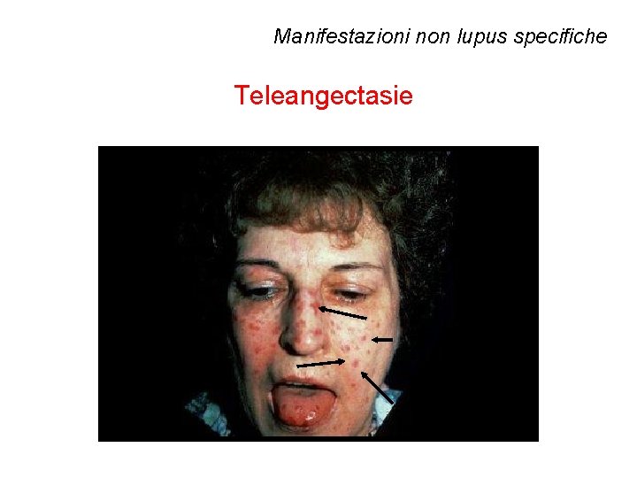 Manifestazioni non lupus specifiche Teleangectasie 
